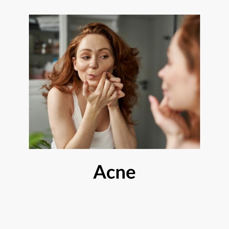 Cosmetics for Acne - 4 Seasons Beauty