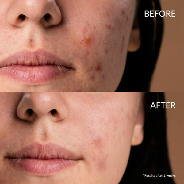 Przeciwtrądzikowe serum do twarzy efekty przed i po kilku tygodniach stosowania